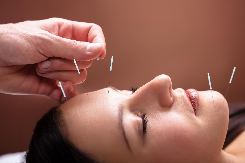 acupuncture for sciatica in Hollywood